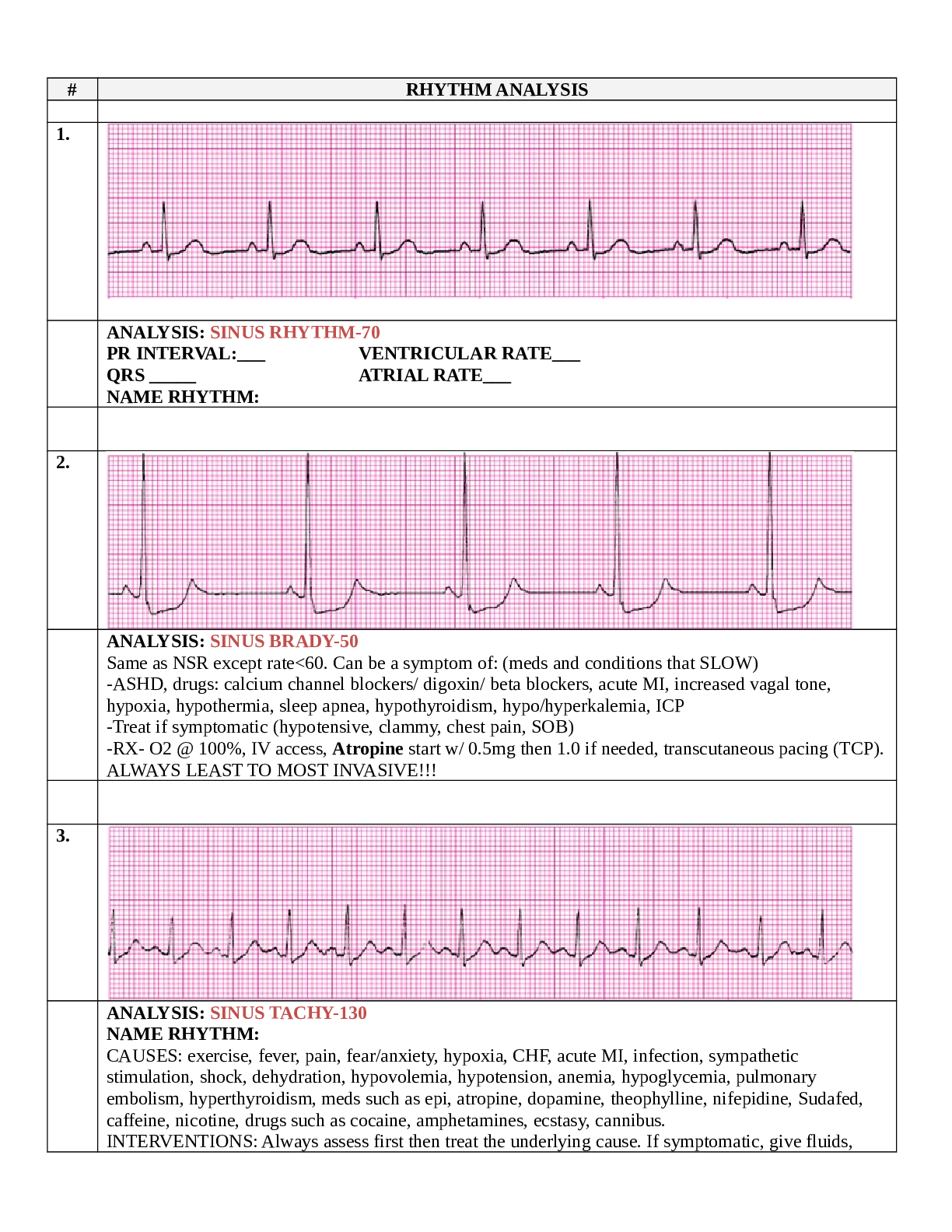 Preview of NURSING NUR 2222 EKG updated; RYTHM ANALYSIS | Already GRADED A.